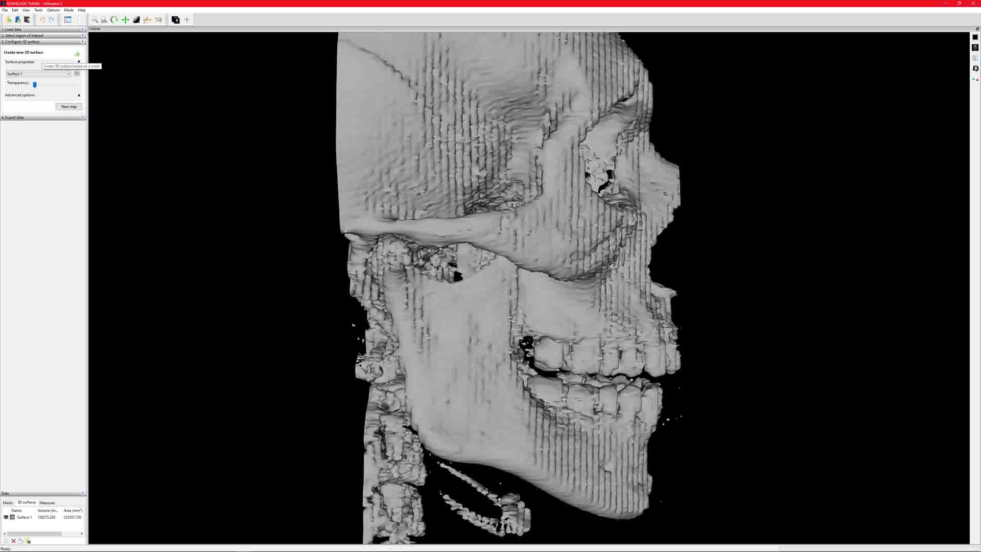 MRI